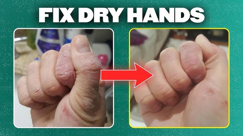 How to Heal Dry Hands With Creams: Effective Tips That Work